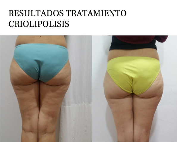 Resultados Criolipólisis